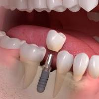 Nepean Dental Implants image 3